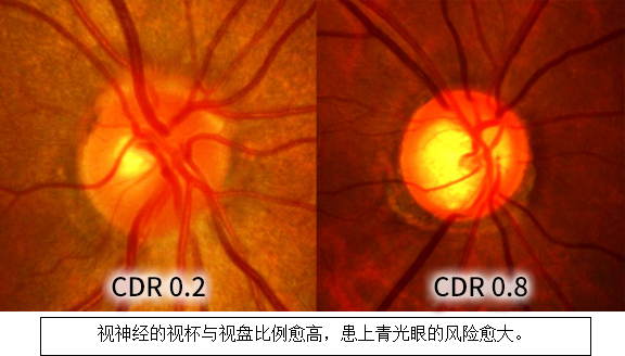 眼压「正常」也会患上青光眼吗?