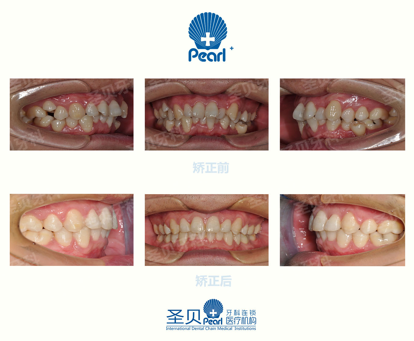 協調(前牙開合,深覆合),牙弓寬度不調(後牙鎖合,反合,磨牙關係不對稱