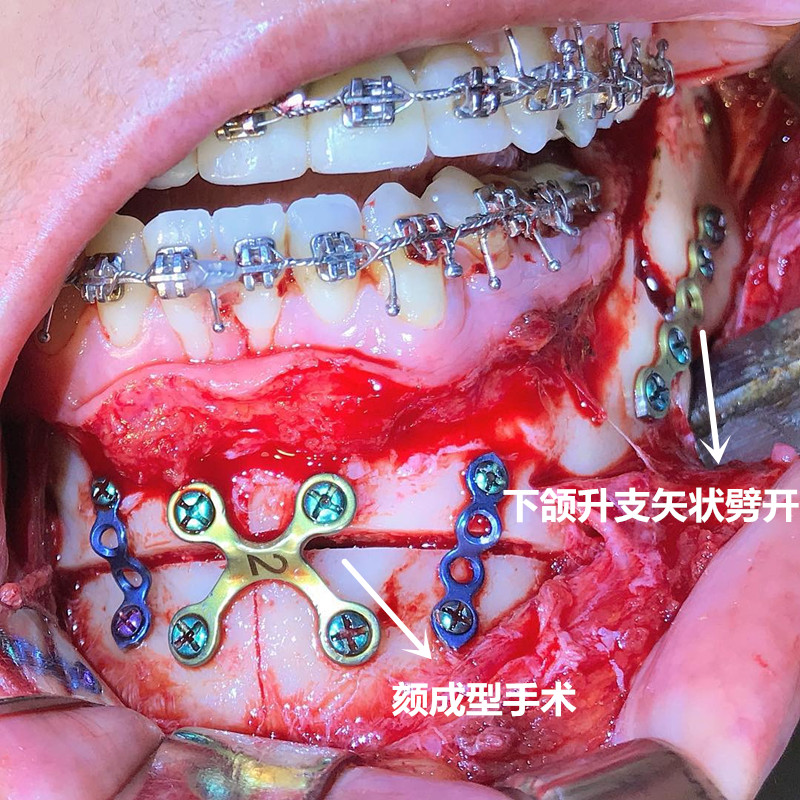 反颌矫正术图片