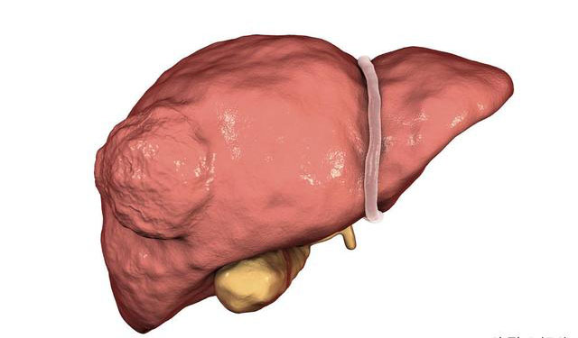 肝血管瘤症状图片