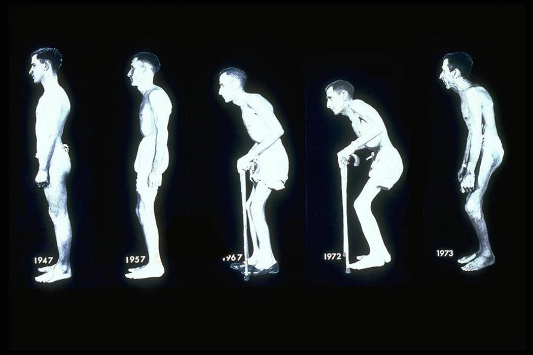 什么样的人会得强直性脊柱炎