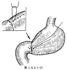 胃大部切除术后并发症及营养治疗