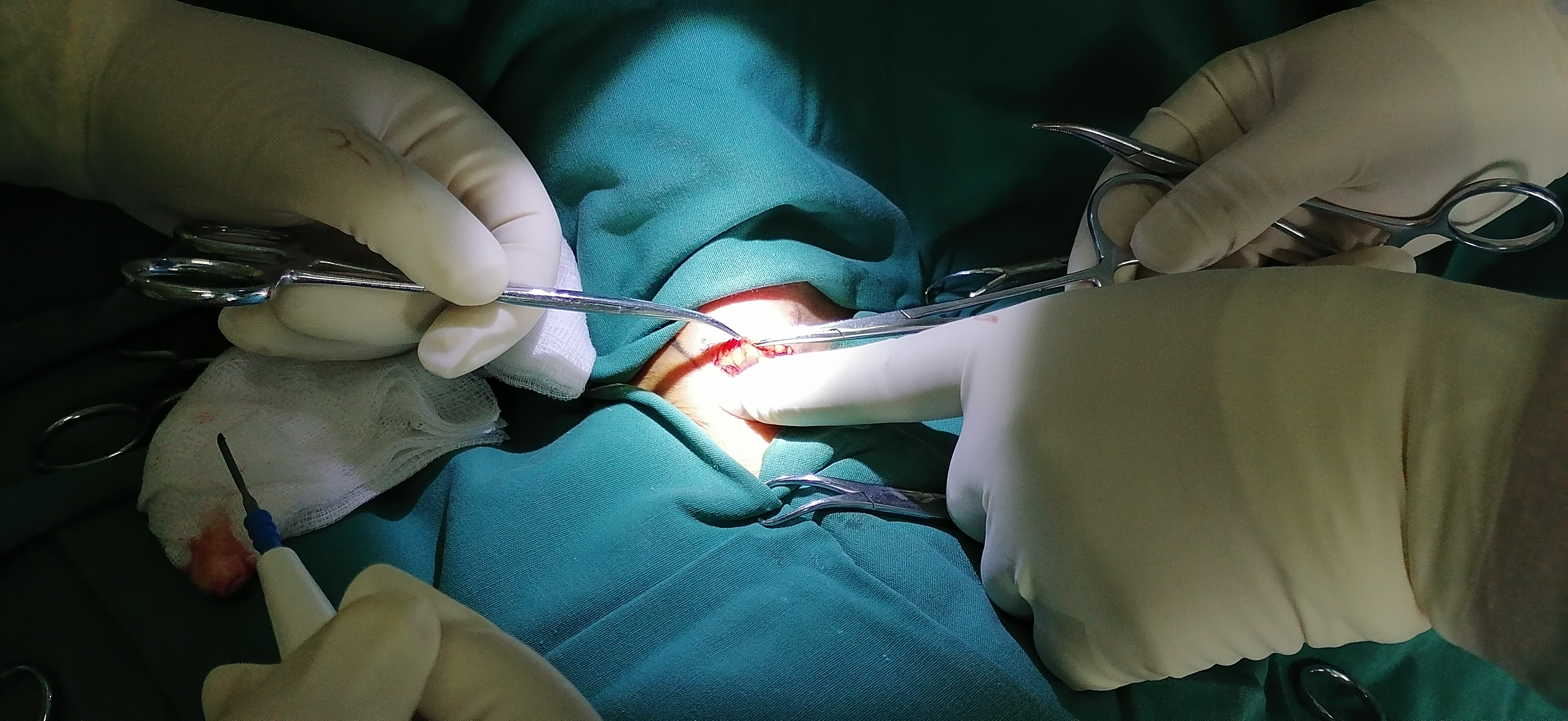 icu中部分患者为何需要气管切开