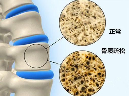 但是这位患者入院之后,进行骨密度检测发现骨密度比较差,是骨质疏松症