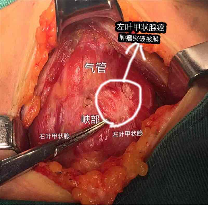 甲状腺固有被膜图片