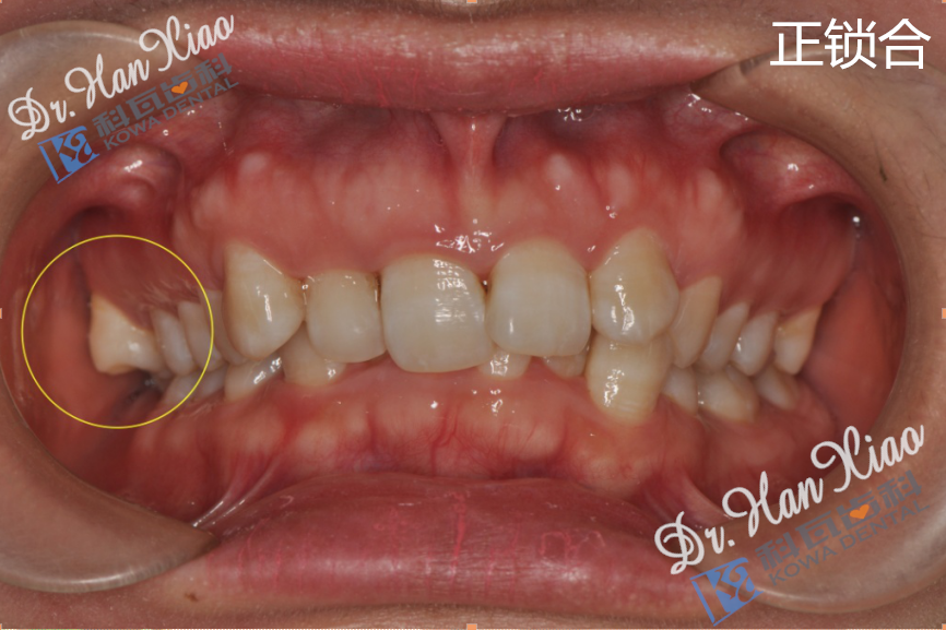 你的牙没缺没烂就是嚼不动有可能是后牙锁合在搞事情