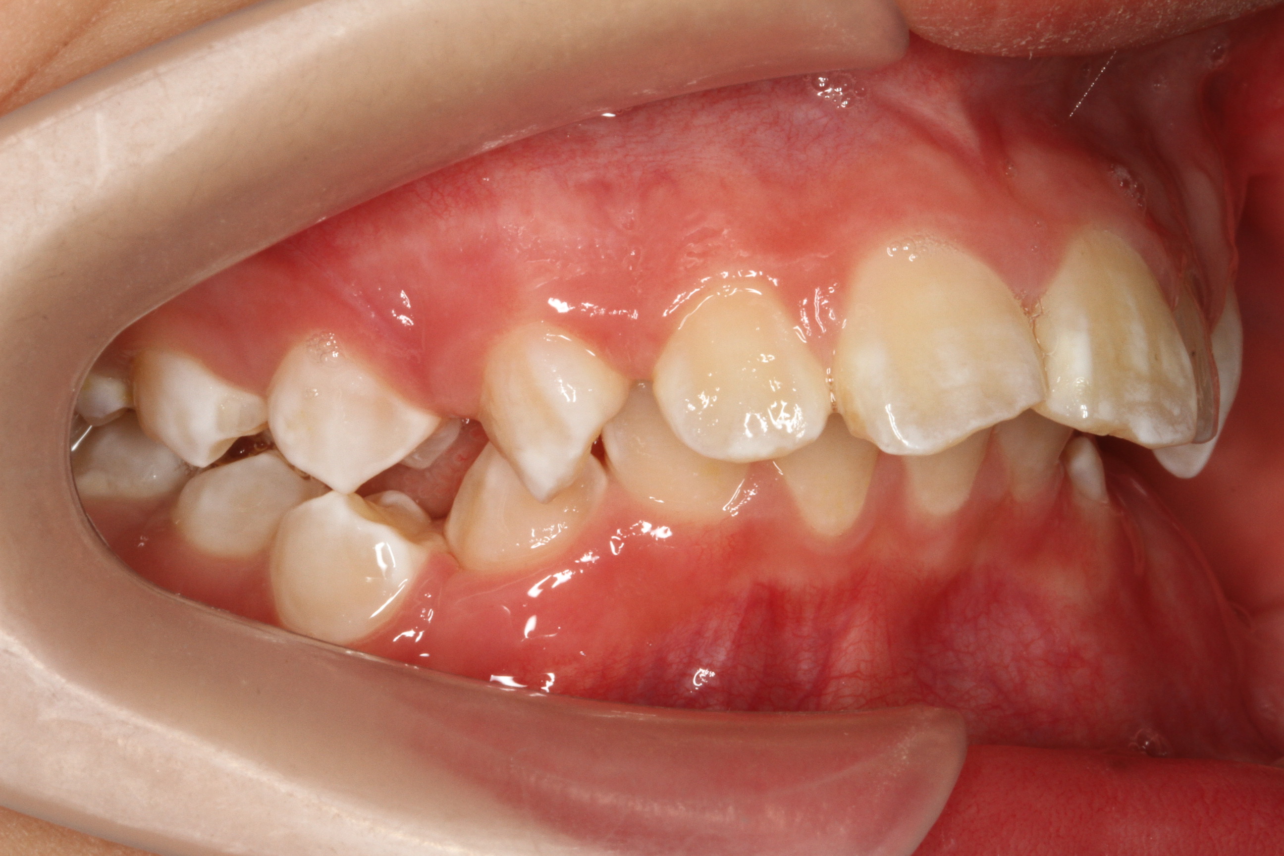 儿童龅牙的早期矫治——病因对策和双期矫治