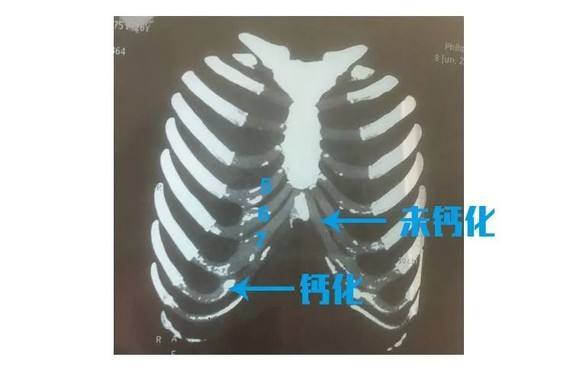 已经钙化的肋软骨为什么不能用作耳再造手术材料呢?