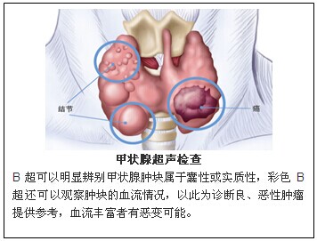 漫画甲状腺瘤是不是甲状腺癌