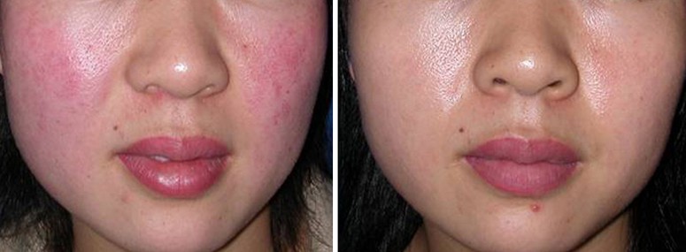 祛掉红血丝是变身网红的第一步