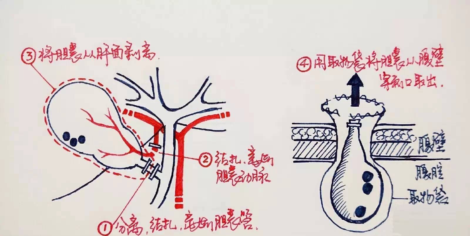 腹腔镜下胆囊切除术是一种微创,成熟,低风险的手术,对于有手术指征的