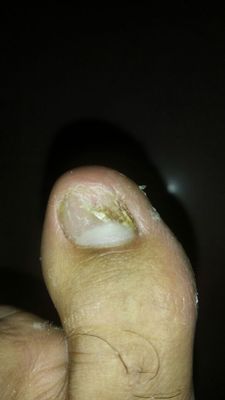 大拇指,不管是手上还是脚上,得灰指甲概率都很高.