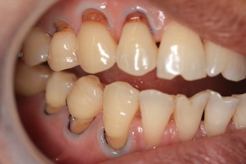 自己牙齿有冷热敏感,酸痛的感觉,照镜子发现牙齿颈部有缺损,一定是患