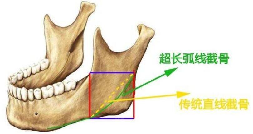 长曲线下颌角截骨有什么优势