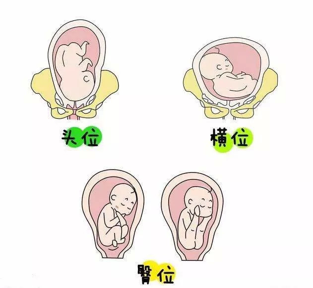 胎宝宝在肚子里打坐,还能顺产吗?