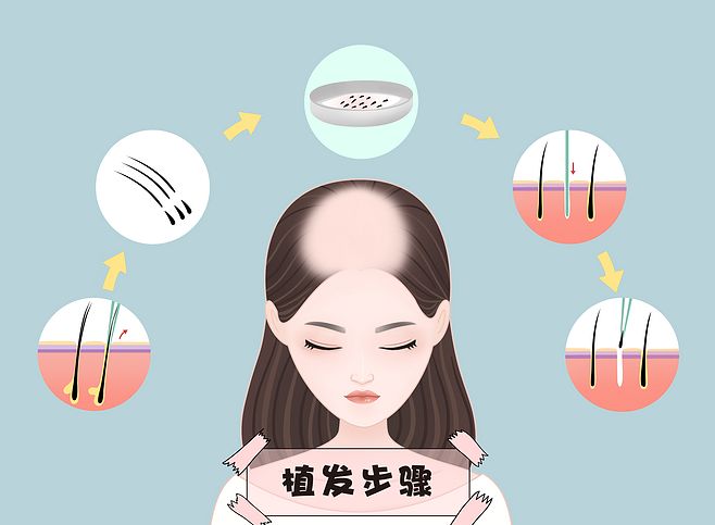 为什么现在植发技术这么成熟毛囊成活率却达不到100%?