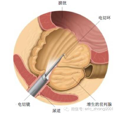 前列腺增生手术示意图图片