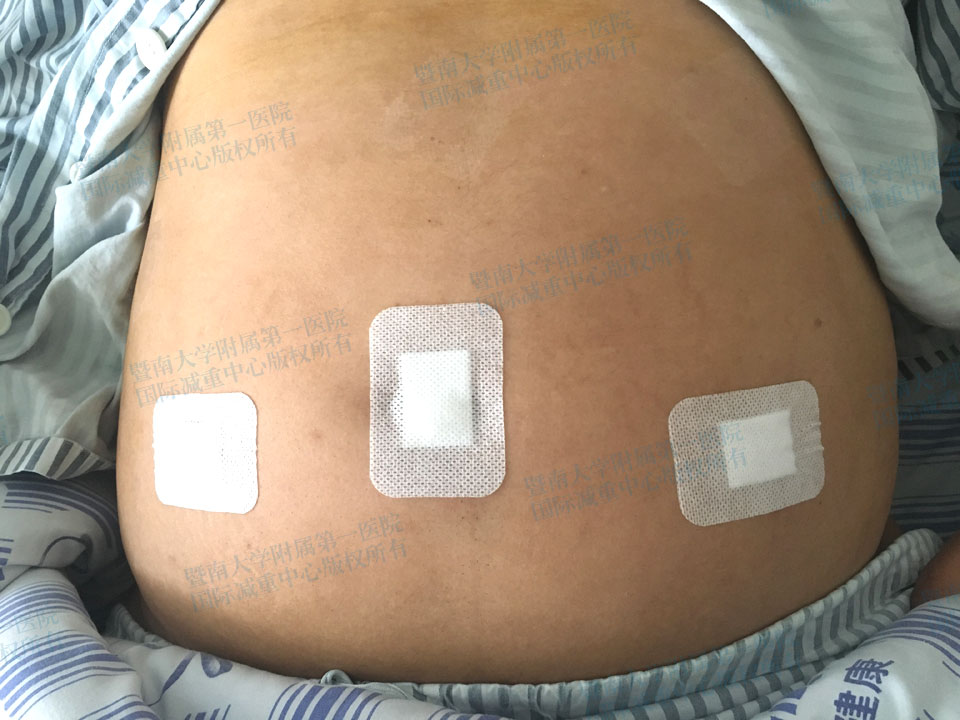 原来的减肥手术有很多种,包括袖状胃,胃旁路,胃束带,胃转流,胃折叠,缩