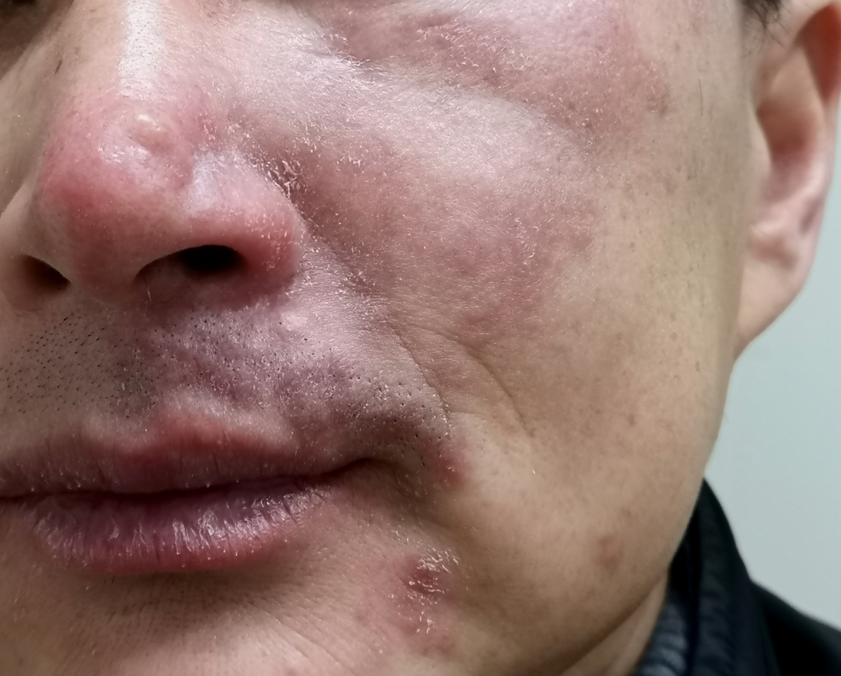 伴有发热的皮肤病(三):结缔组织病_朱敏刚_主任医师_爱问健康