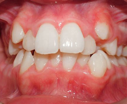 孩子牙齿出现这些畸形要注意