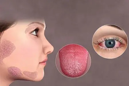 除了干燥综合症部分,正常的老年人也会出现口干眼干.