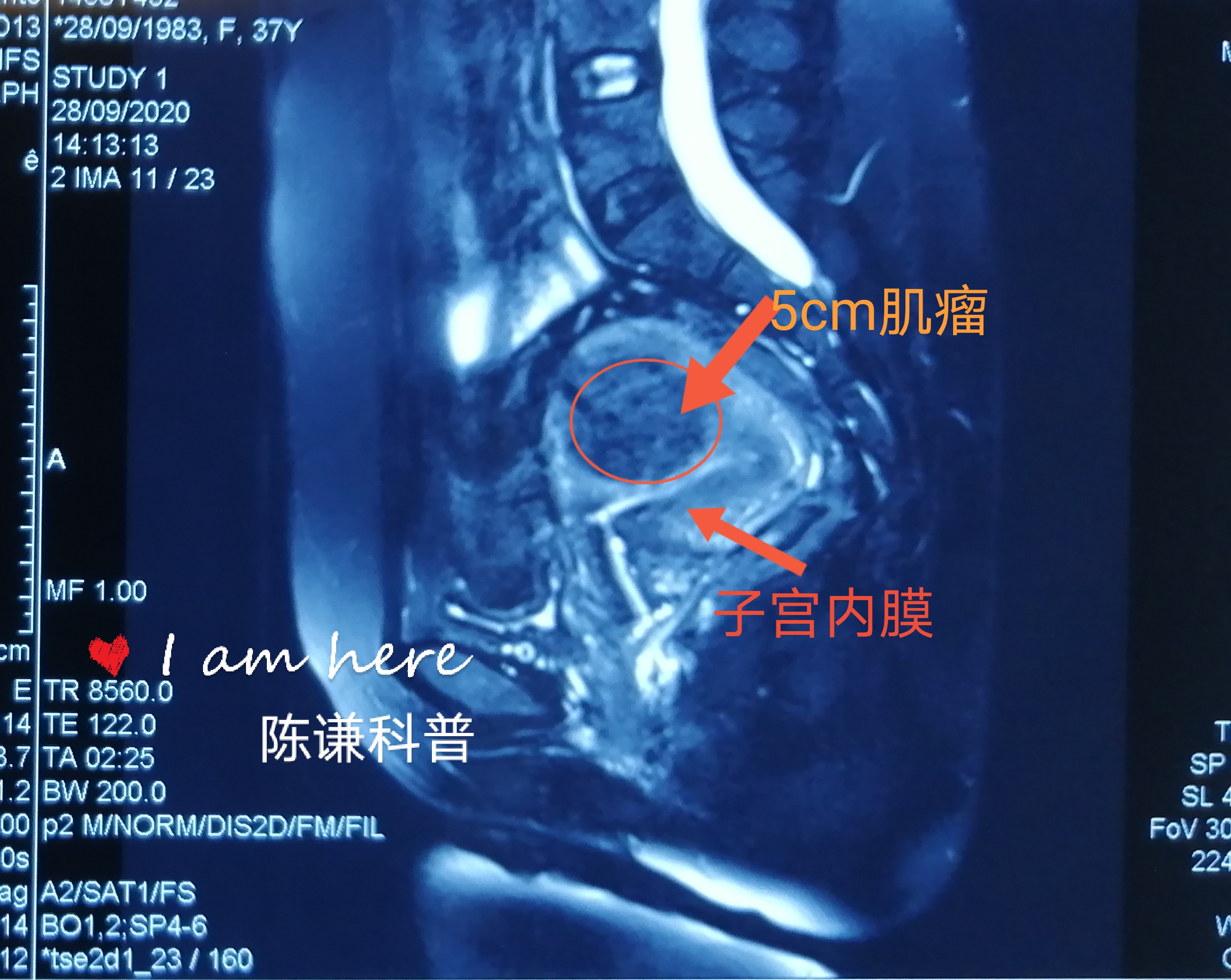 子宫底肌壁间子宫肌瘤图片