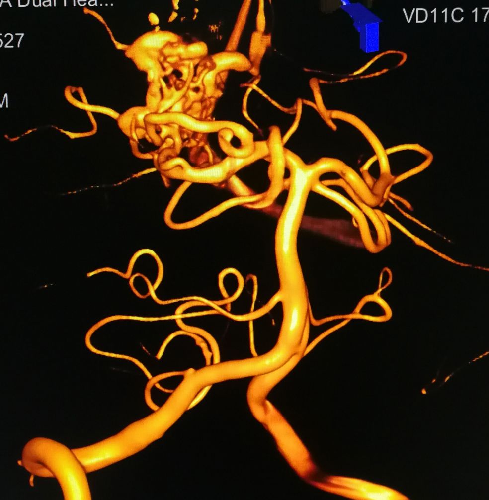 dr.盖延廷 | 脑血管畸形-脑子里的一团乱麻