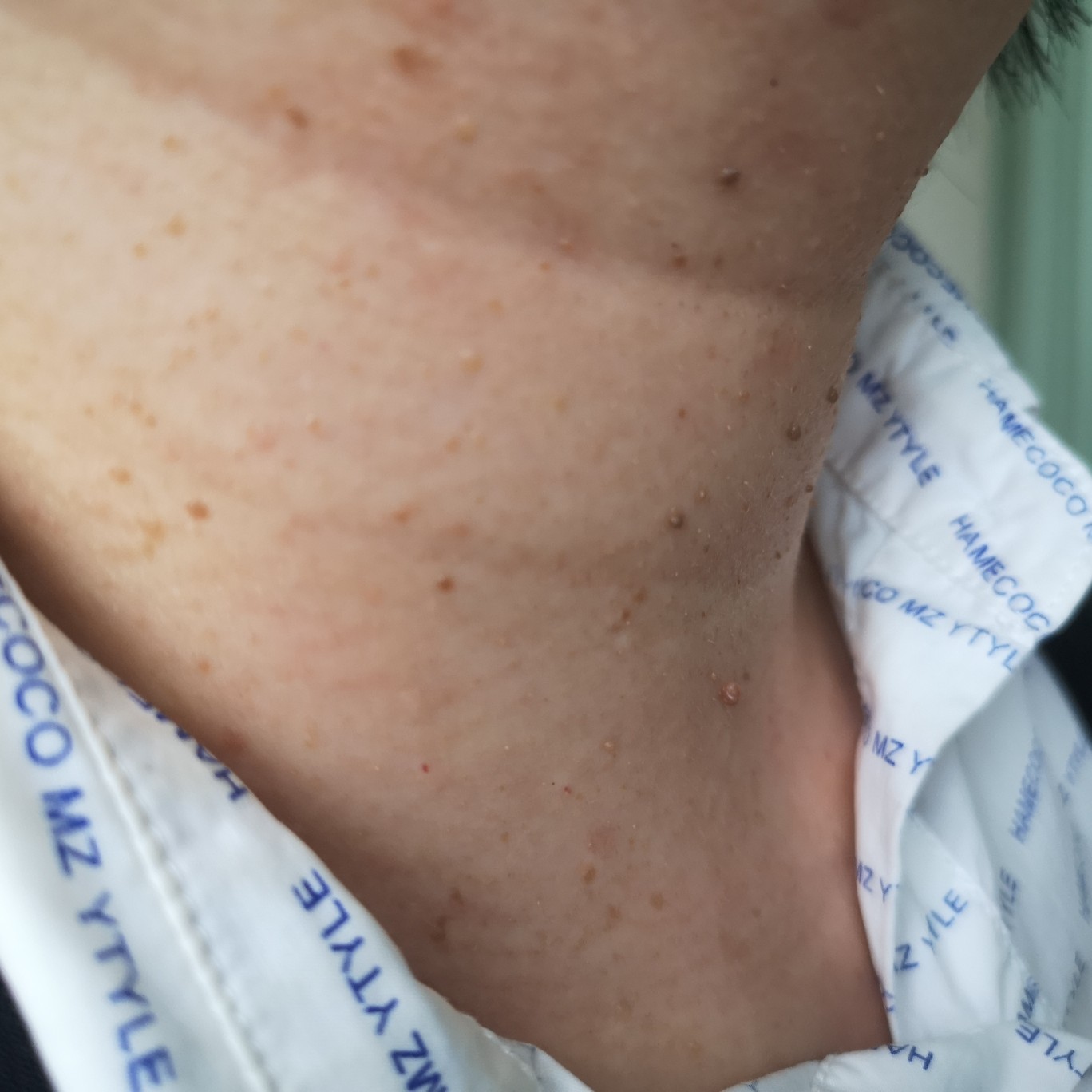 脖子上的小疙瘩,真的不是丝状疣!