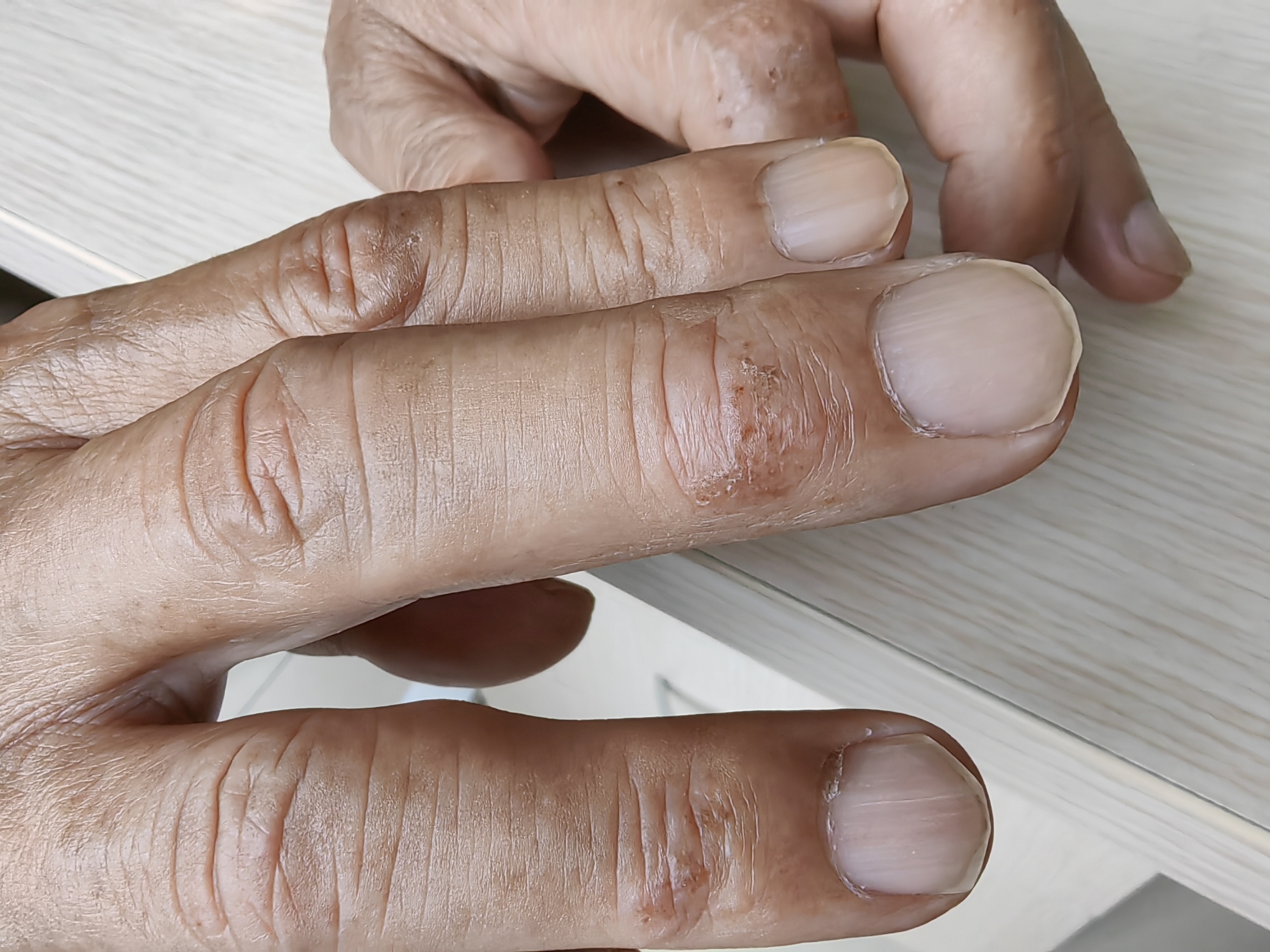 接触性皮炎和湿疹,傻傻分不清!-朱敏刚主任医师-爱问医生