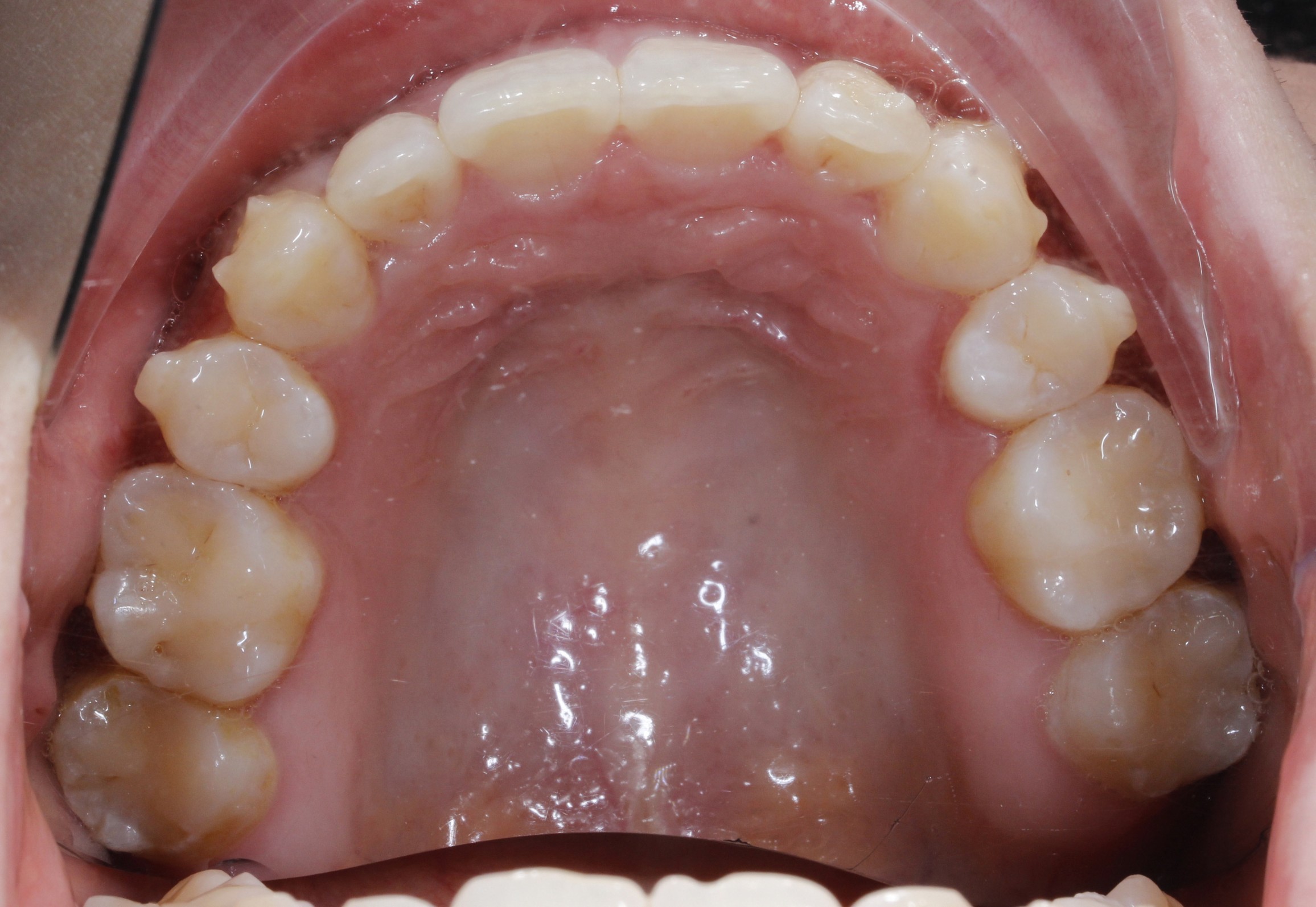 矫正微调前后对比照:现在患者在微调中,牙齿已经排列整齐 ,前牙内收