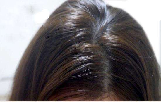 四,连根掉发头发如果连根一起掉,它代表的意义是毛囊进入了休止期