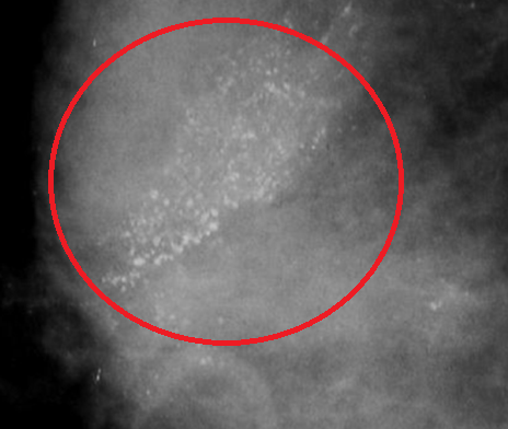 乳腺4a类一般良性 钙化图片