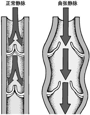 下肢静脉曲张最主要的发病机制是大隐静脉汇入深静脉处的瓣膜发生关闭