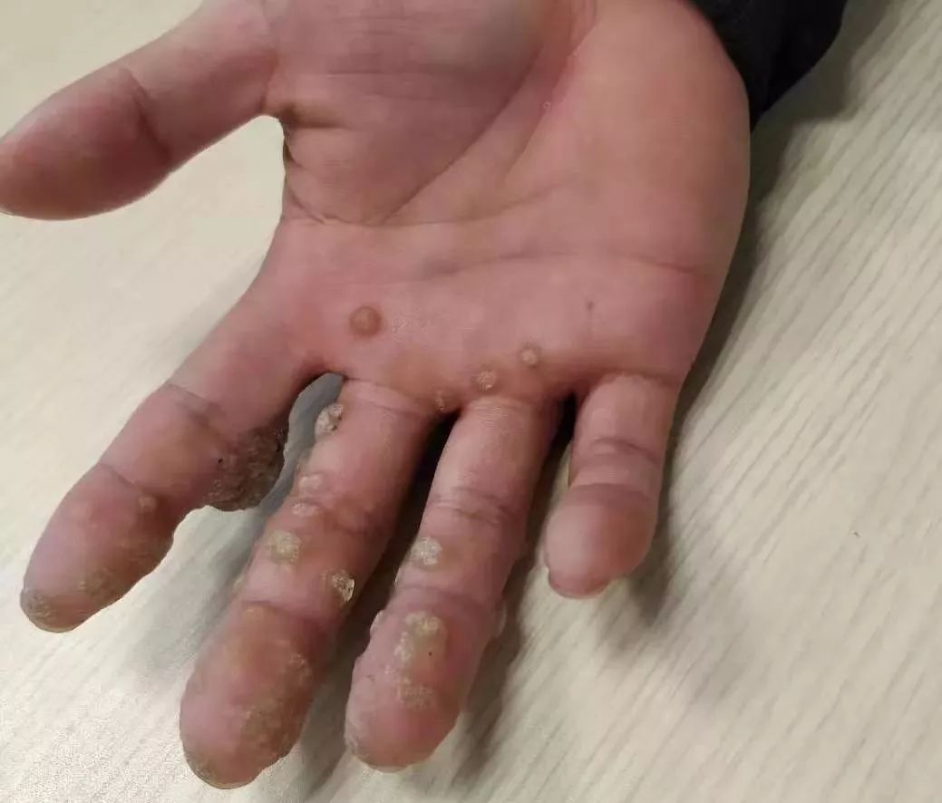 不是万能的冷冻疣的治疗