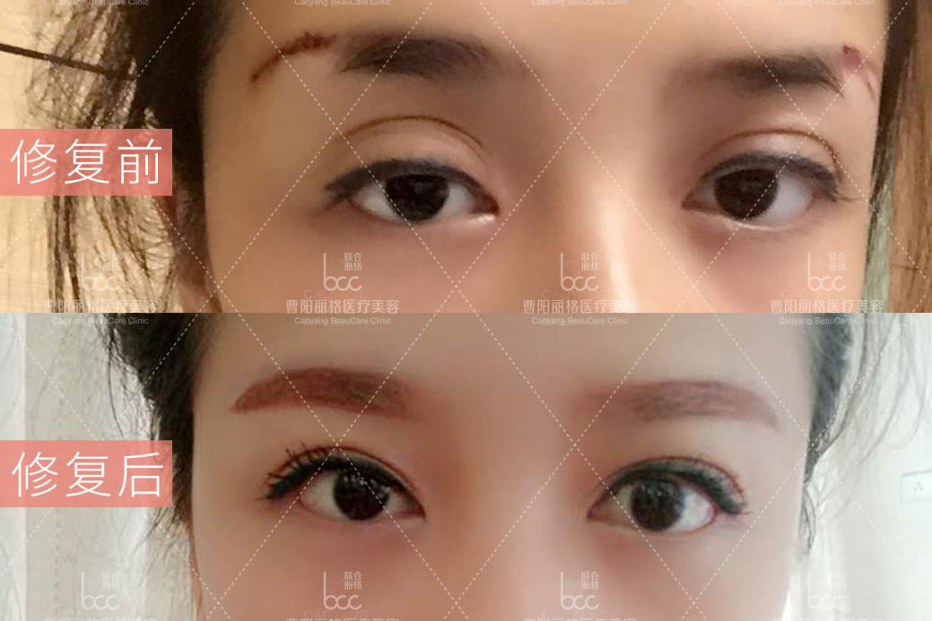双眼皮修复常见的几种情况