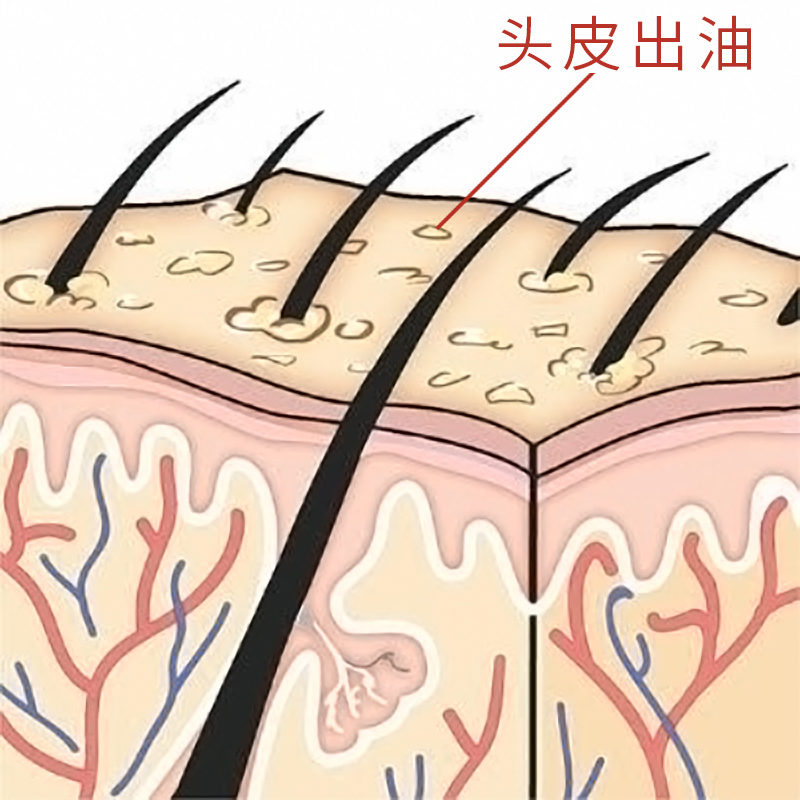头皮出油的真正原因是什么控油洗发水有用吗