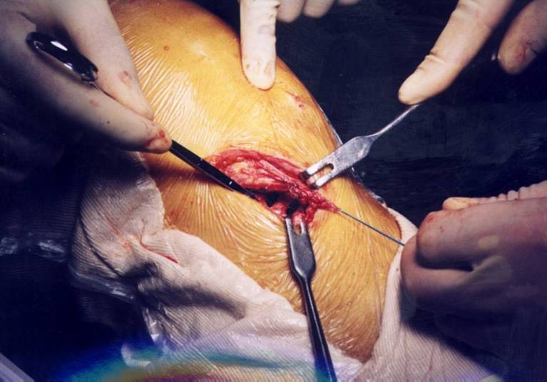 有关内侧副韧带(mcl)一些小知识