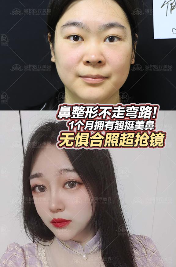 鼻整形不走弯路 1个月拥有翘挺美鼻无惧合照超抢镜 蒋亚楠副主任医师 爱问医生