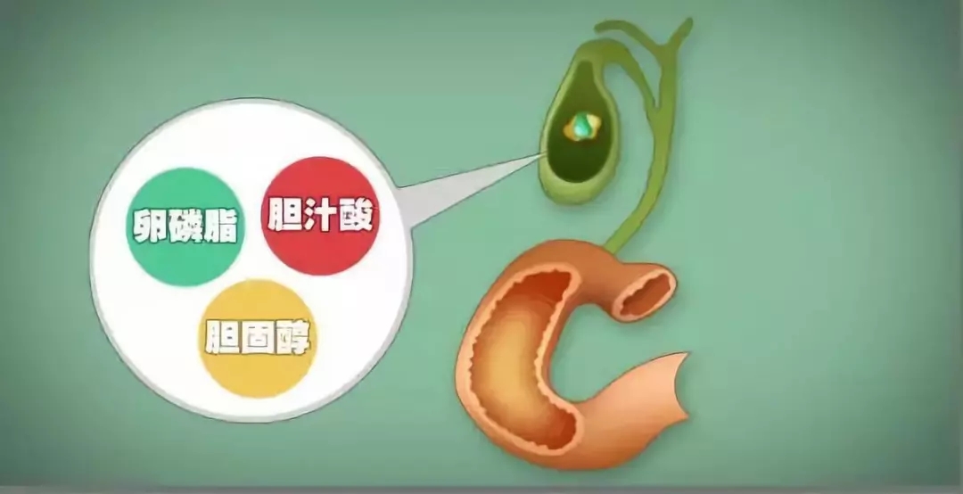 胆汁里有很多成分,一般情况下都是呈溶解的状态,就像糖跟盐都溶解在水