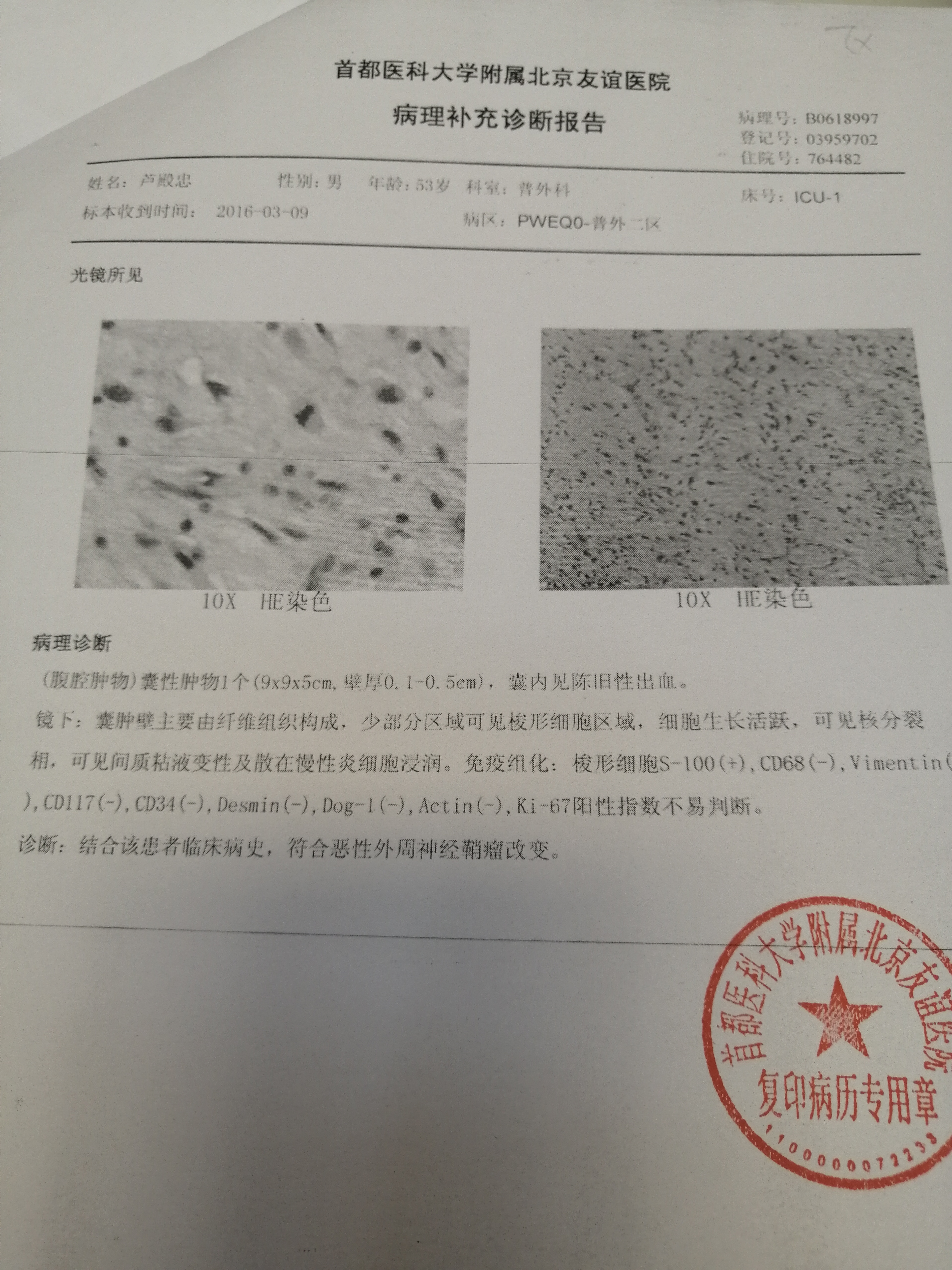 恶性神经鞘瘤诊治病例分享