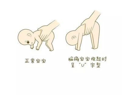 脑瘫宝宝握拳图正常图片