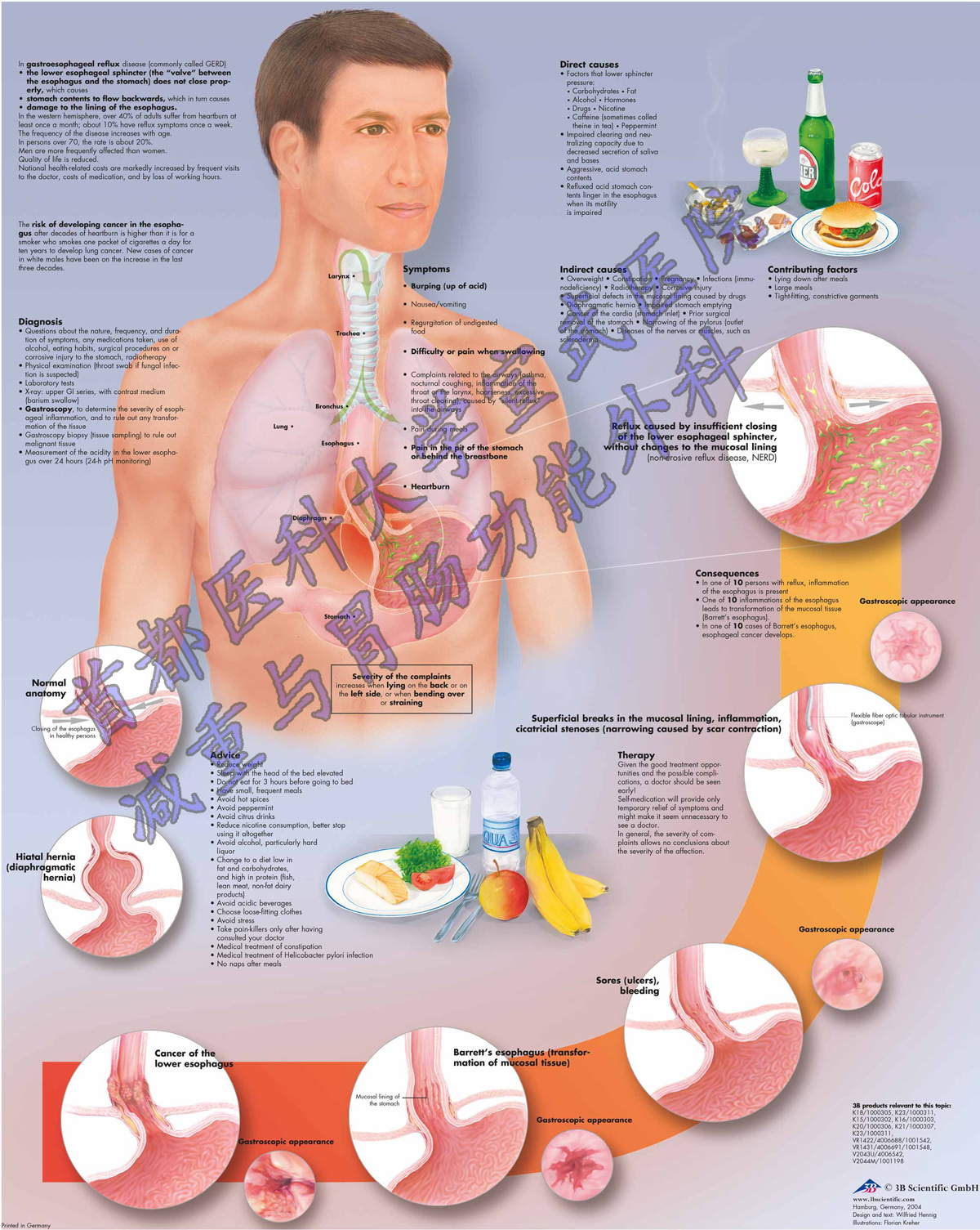 vr1711uu_01_3200_3200_gastroesophageal-reflux-disease-chart-gerd