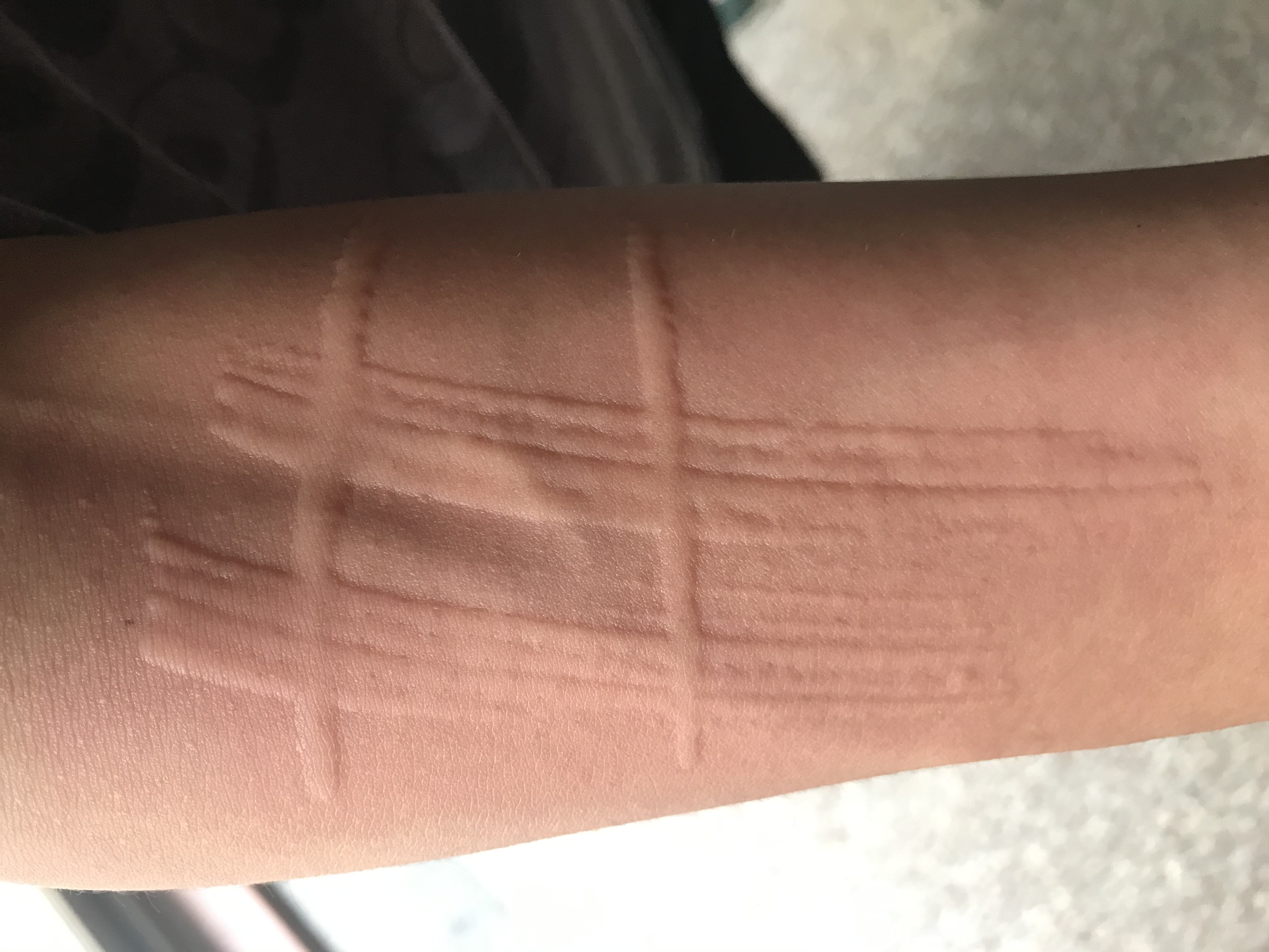 皮肤上能写字的皮肤病,你见过吗?