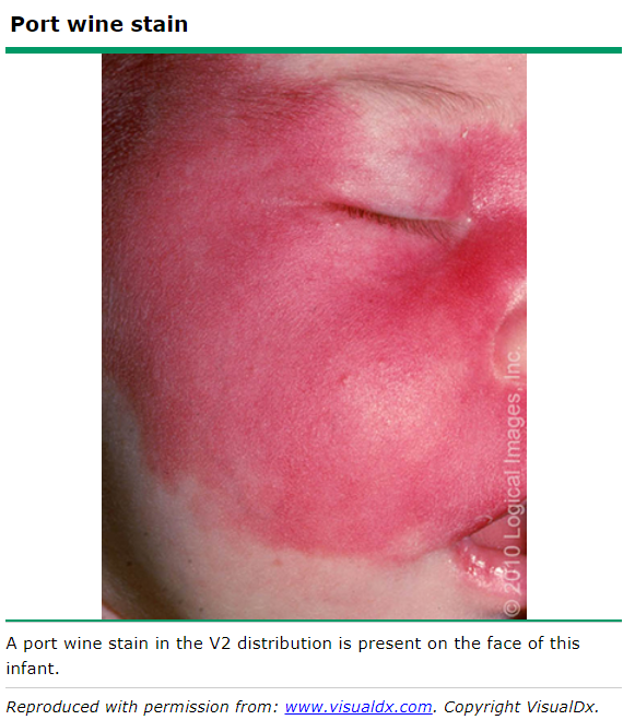 鮮紅斑痣,出自 uptodate
