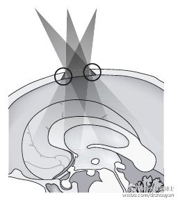 必须保护好桥静脉,以避免大脑静脉性梗塞.