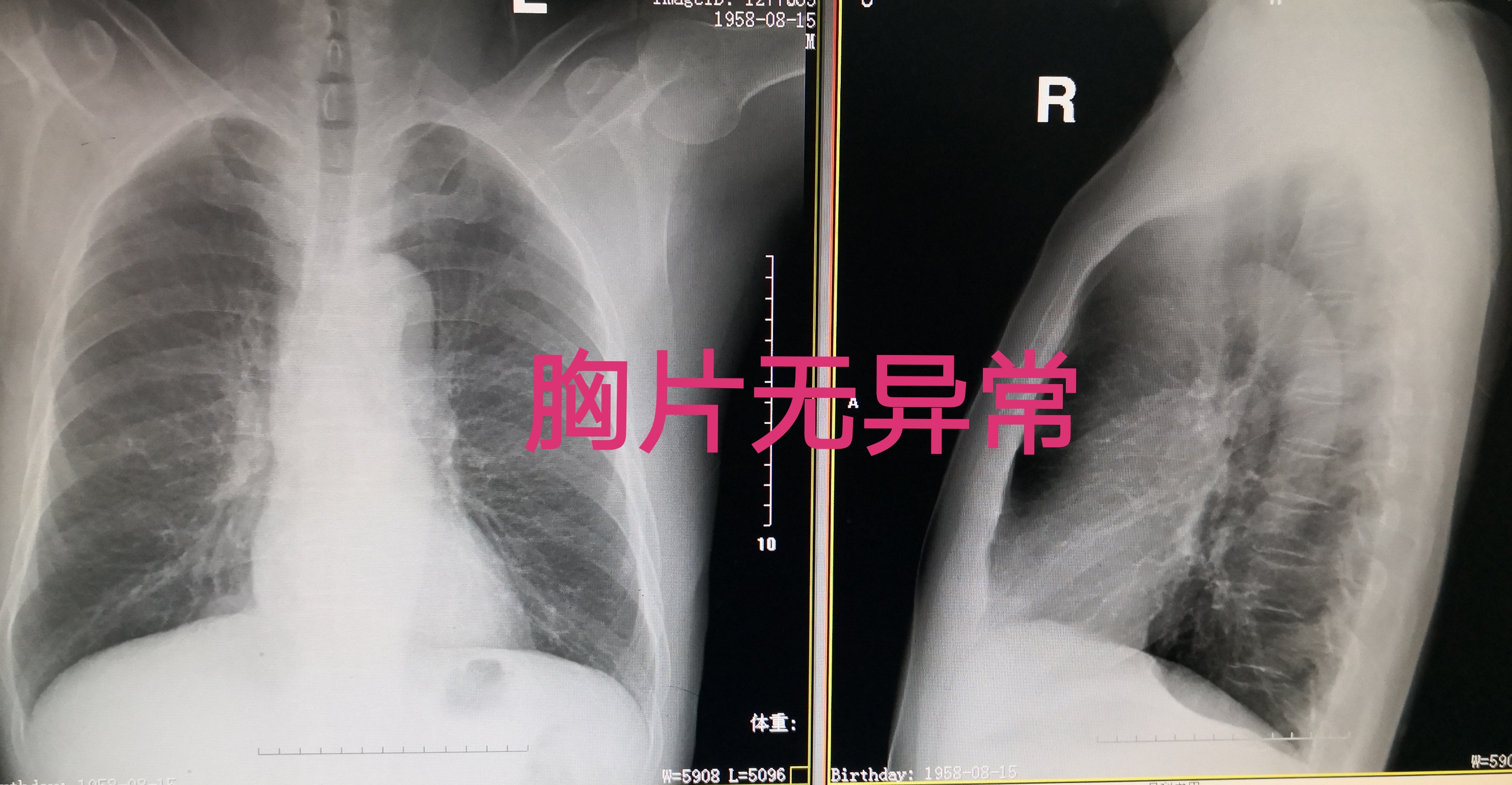 的男性,吸烟多年,每天两包,咳嗽了一个半月还不见好,在当地医院做胸片