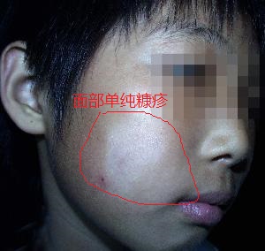 "桃花癣"还有这么好听的病!