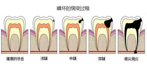 患了齲齒一定要補,淺齲不治療,會進一步發展,並不會自愈.