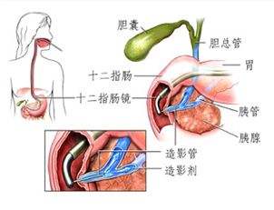 ercp不仅仅是检查,竟然还能做这么多治疗!