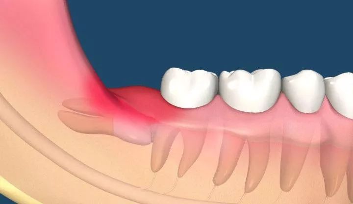 我的智齿该拔吗?可是我怕疼.怎么办!
